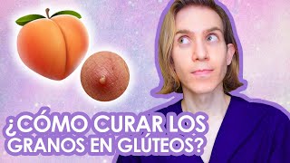 GRANOS en GLUTEOS Causas tratamientos productos para comprar [upl. by Attennhoj603]