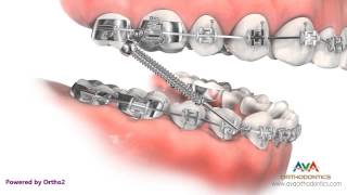 Orthodontic Treatment for Overjet Overbite  Forsus Appliance [upl. by Estus623]