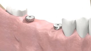 SIC invent Dental Implant  Prosthetic Animation BridgeWork Open Tray Technique [upl. by Nemaj475]