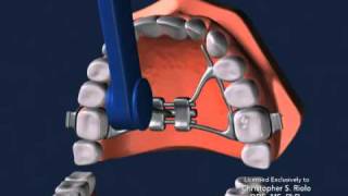 Seattle Orthodontist Dr Christopher Riolo Banded Expander RPE [upl. by Edita]