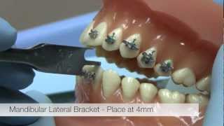 American Orthodontics Alexander LTS Brackets  Bracket Placement Video [upl. by Peursem]