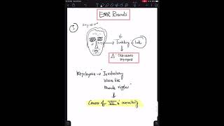 Case 4 Orbicularis Myokymia  Facial Nerve Overactivity [upl. by Evered]