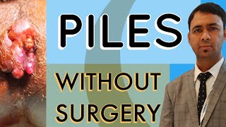 PILES TREATMENT  WITHOUT SURGERY [upl. by Rondi]