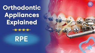 Orthodontic Appliances Explained  RPE [upl. by Sirehc]