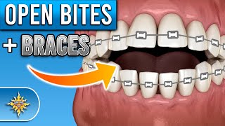 How Do Braces Fix Open Bites  Premier Orthodontics [upl. by Aisereht498]