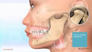 Carriere® Motion™ Appliance for Class II Patient Education Animation 2 [upl. by Auqinet304]