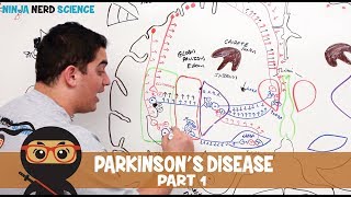 4 Progression of Parkinsons Disease [upl. by Grewitz527]