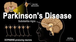 Understanding Parkinson’s Disease [upl. by Nod]