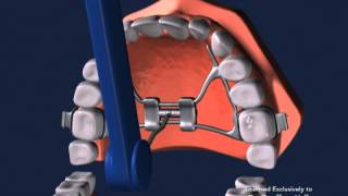 Advanced Orthodontics  Expanders [upl. by Adalheid820]