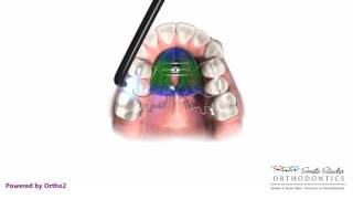 Pendex  Orthodontic Appliance [upl. by Ellinet]