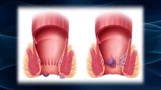 Hurting From Hemorrhoids [upl. by Annayad]