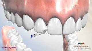 Interproximal Reduction or IPR  Polishing Strip [upl. by Ajam]