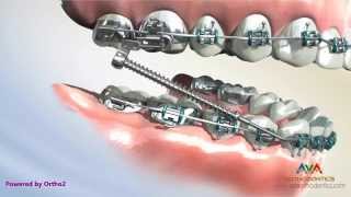 Different Types of Forsus  Orthodontic Appliance [upl. by Githens]