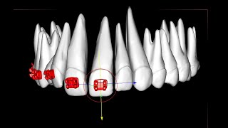 Placing orthodontic brackets on central incisors [upl. by Krause]