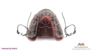 Orthodontic Expander or Spacer  Quad Helix Appliance [upl. by Einnaf]