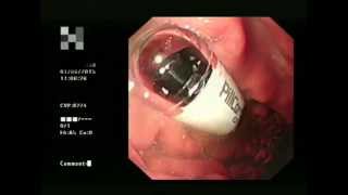 Capsule Endoscopy a helping hand [upl. by Medwin]