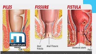 Piles Symptoms Causes And Treatment Dr2PM [upl. by Jaynell22]